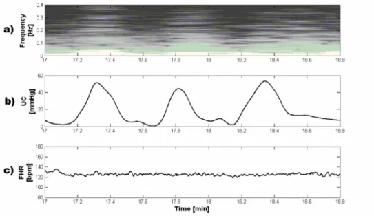 Figure 13: example of FHRV spectral modifications in correspondence of UC. From the top, spectrogram,  evaluated by means of STFT, and US-CTG signal of the subject #24 (UC in 2b, FHR in 2c)