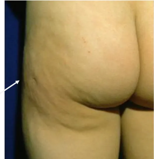 Figura 2: la placca giallastra della coscia sinistra nella paziente SC. Si nota la  cicatrice depressa, sede della biopsia cutanea
