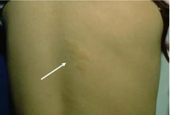 Figura 4: comparsa di alcune placche di colore giallastro a livello del dorso, in  regione paravertebrale destra, nella paziente SC