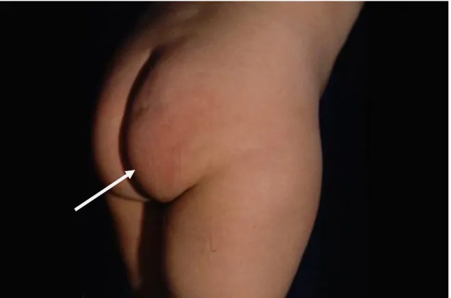 Figura  5:  comparsa  di  una  placca    di  colore  roseo  a  livello  del  gluteo  destro  nella paziente HC