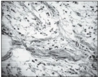 Fig. 4: Referto anatomopatologico  microscopico: tessuto neurofibroso   con severa infiltrazione di eosinofili   e plasmacellule e pochi istiociti