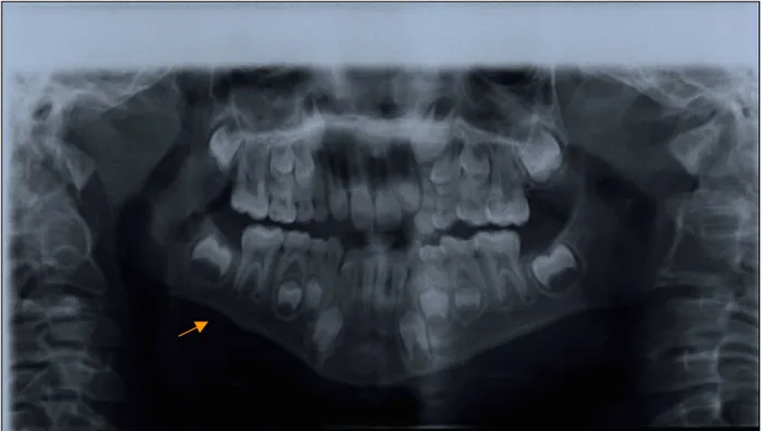 Fig.  21:  B.S.,  8  anni.  Si  evidenzia  la  deformazione  di  tutto  il  bordo  inferiore della mandibola, tipo “dentellatura” 