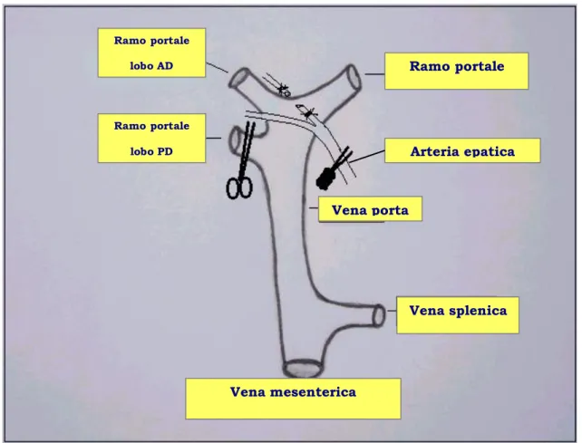 Fig. 10: Clampaggio selettivo ramo portale PD, legatura arteria epatica  sinistra, clampaggio arteria epatica destra   