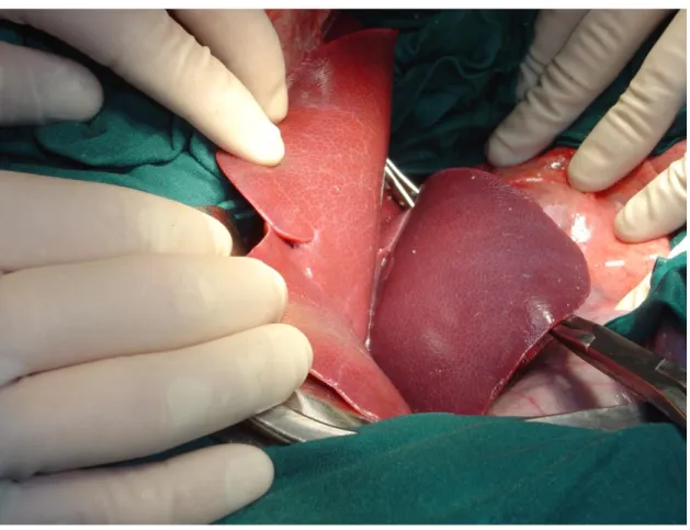 Fig. 11: Clampaggio selettivo ramo portale PD, legatura arteria epatica  sinistra, clampaggio arteria epatica destra 