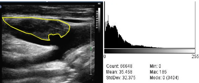 Figura  1:  Valutazione  ultrasonografica  della  placca  carotidea  mediante  calcolo  del GSM