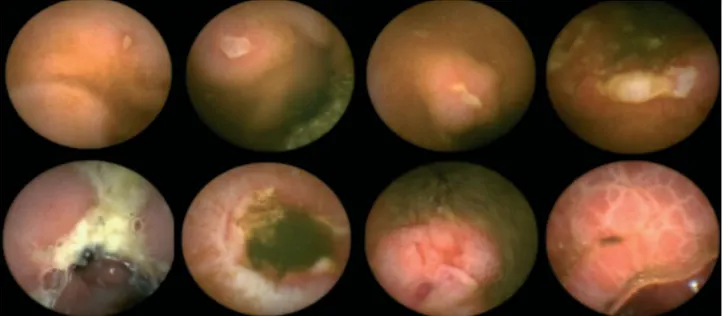 Figura 3. Immagini alla videocapsula prima del trattamento