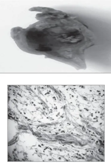 Fig. 4: Referto anatomopatologico  microscopico: tessuto neurofibroso  con severa infiltrazione di eosinofili  e plasmacellule e pochi istiociti
