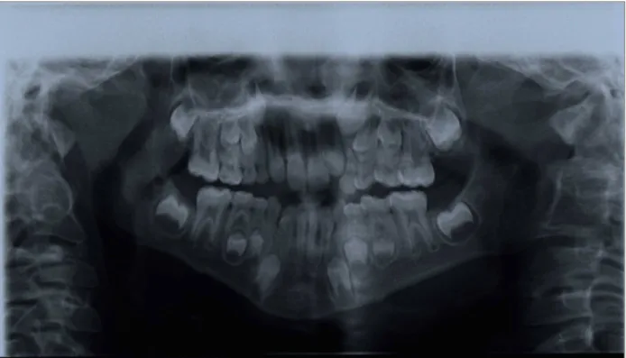 Fig. 5: B.S., 8 anni. Si evidenzia la deformazione di tutto il bordo  inferiore della mandibola, tipo “dentellatura”