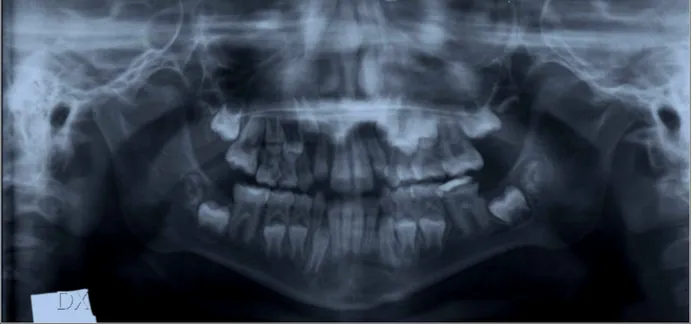 Fig.   12:   G.C.,   7   anni.   Si   evidenziano   elementi   dentali   36   e   46  taurodonti,   aumento   dell’incisura   coronoide   di   dx,   aumento  dell’angolo goniaco.