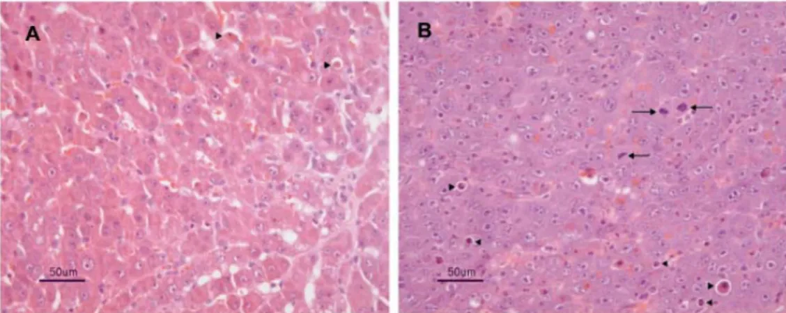 Fig 5:  Carcinomi epatocellulari ben differenziati (A) e poco differenziati (B).  (A): 