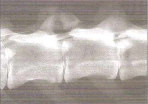 Fig  1.3  Frattura  di  una  faccetta  articolare  messa  in  evidenza  grazie  ad  una  proiezione  radiografica obliqua (Da “Small animal spinal  disorders” Sharp N, Wheeler S, 2005)
