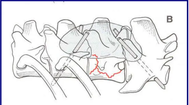 Fig  2.5  Fissazione  con  chiodi  e  cemento  (Da  “Small  animal spinal disorders” Sharp N, Wheeler S) 