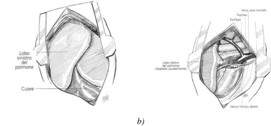 fig. 9.7 a)  -  Dopo aver inciso la pleura parietale sinistra si inserisce un  divaricatore, rendendo così immediata la visione del polmone (Dàvid et al; 2004)