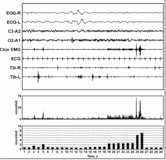 Figura 2. Esempio di rettificazione e quantificazione dell’ampiezza del segnale EMG del  muscolo miloioideo in un’epoca di sonno REM in un paziente con RBD idiopatico