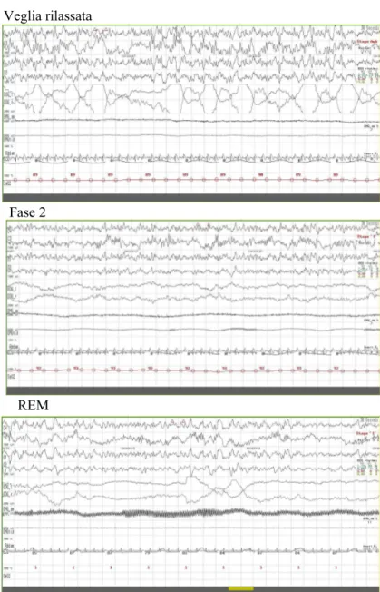 Figura 3: Aspetti polisonnografici della veglia e delle diverse fasi del sonno del paziente 1 (M, 24 aa) 