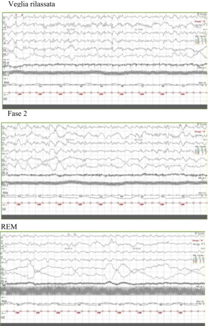 Figura 5: Aspetti polisonnografici della veglia e delle diverse fasi del sonno del paziente 2 (F, 34 aa)  