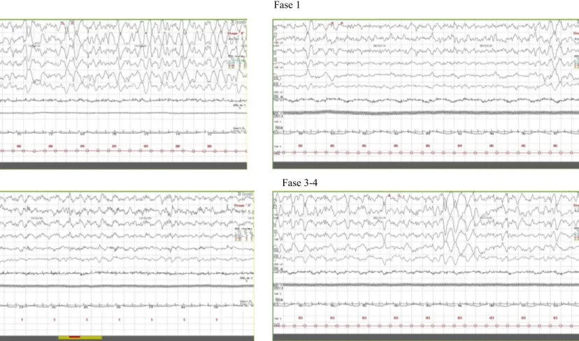Figura 7: Aspetti polisonnografici della veglia e delle diverse fasi del sonno del paziente 3 (M, 28 aa)  