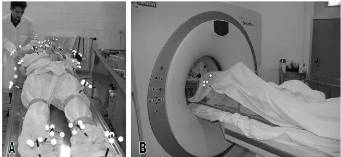 Figure 2. The cadaver with reflective markers set on (A). The cadaver during CT-scan session (B)