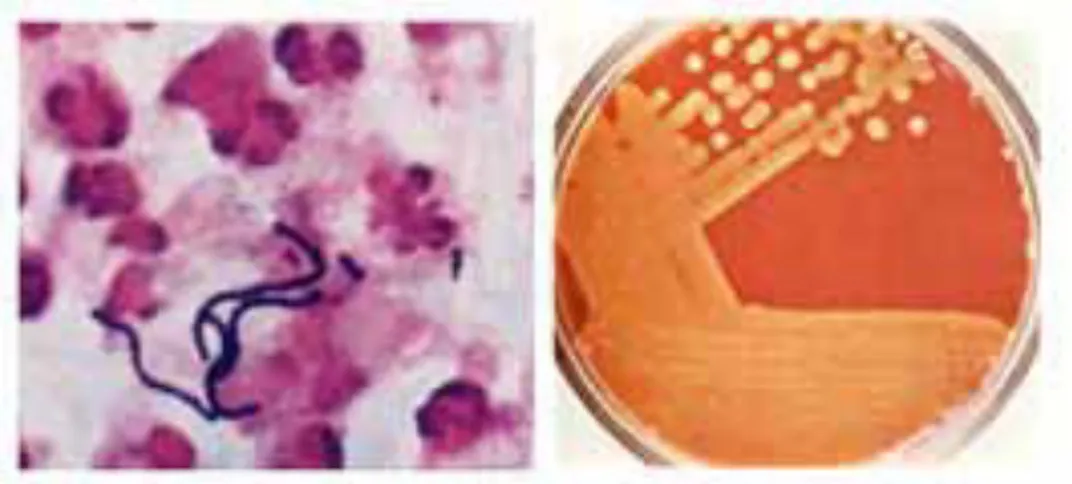 Figure 1.2.  Streptococcus pyogenes.  Left: Gram stain of S. pyogenes in a clinical specimen