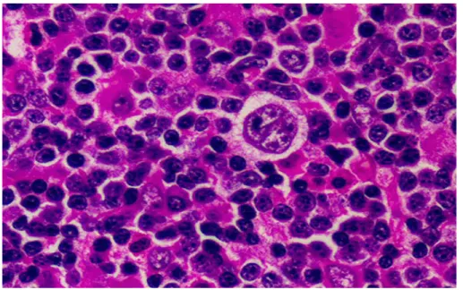 Fig. 9 Cellula di Reed-Sternberg. 