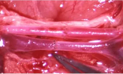 Fig 14. Suture vascolari dirette eseguita direttamente tra i due monconi del vaso e  con innesto interposto (fig 15 a, b) se tra i due monconi viene interposto un  innesto di vena