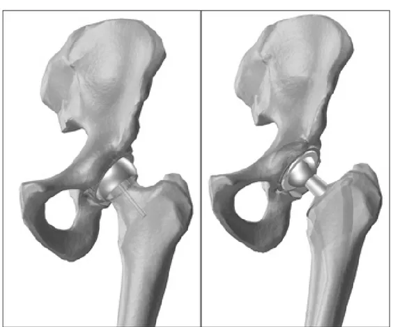 Figure 1 - On the left: a resurfaced hip. On the right: a traditional endomedullary stem