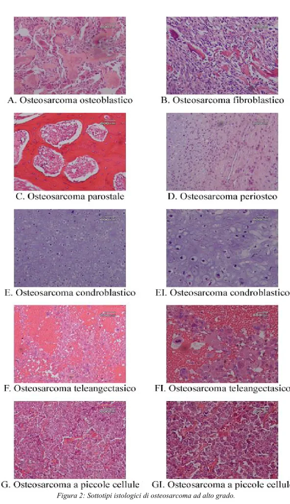 Figura 2: Sottotipi istologici di osteosarcoma ad alto grado.