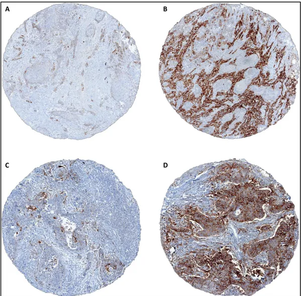 Figure	 1:	 A,	 B:	 discordant	 PD-L1	 expression	 within	 tissue	 cores	 from	 a	 single	 adenocarcinoma	case	(2%	vs	80%);	C,	D:	discordant	PD-L1	expression	within	tissue	 cores	from	a	single	squamous	cell	carcinoma	case	(5%	vs	70%).	 	 	 	 	 	