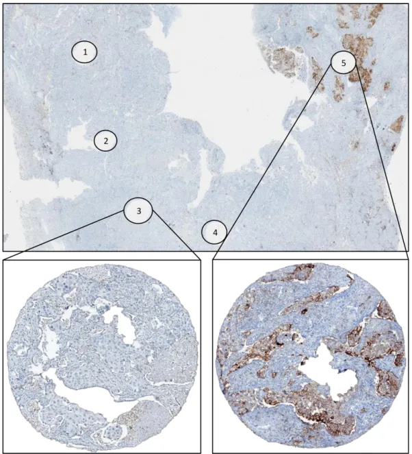 Figure	 2.	 Representative	 image	 for	 PD-L1	 expression	 heterogeneity:	 whole	 section	of	squamous	carcinoma	of	the	lung	stained	with	PD-L1	showing	wholes	 corresponding	to	tissue	microarray	cores,	numbered	1	to	5;	cores	numbered	1	to	 4	have	been	sampl