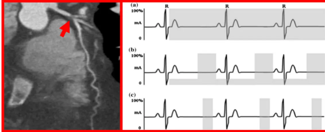 Figure 10. Left Panel: Coronary CTA showing a severe proximal left anterior descending artery lesion highlighted  by  the  red  arrow