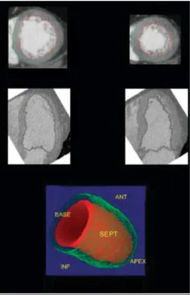 Figure  11.  Evaluation  of  left  ventricular  function  and volume via dual-source CT scanner