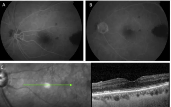 Fig. 2. Fluorescein angiography (FA), and structural spectral domain optical coherence tomography  an-giography (OCT-A) of left eye