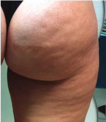 Fig. 1. a 45-year-old woman with widespread alterations to skin tex- tex-ture (orange peel).
