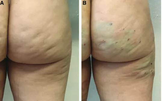 Fig. 7. images pre- (a) and immediately posttreatment (B). the treated areas will look swollen, bruised,  and irregular, but they are already free from retraction.