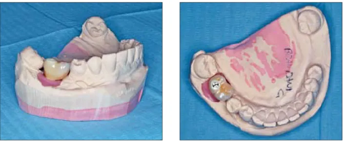 Figs 6a and 6b    Lateral and occlusal views of the master model and zirconia-ceramic crown.