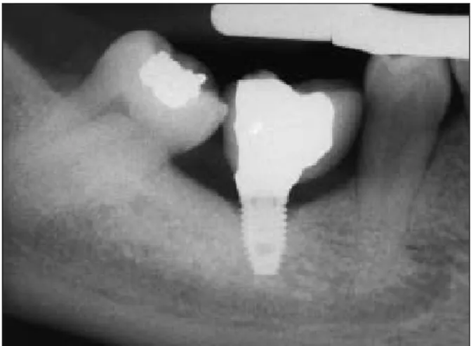 Fig 8    Intraoral radiograph after functional loading (baseline). Fig 9  Intraoral radiograph 1 year after functional loading  (follow-up).