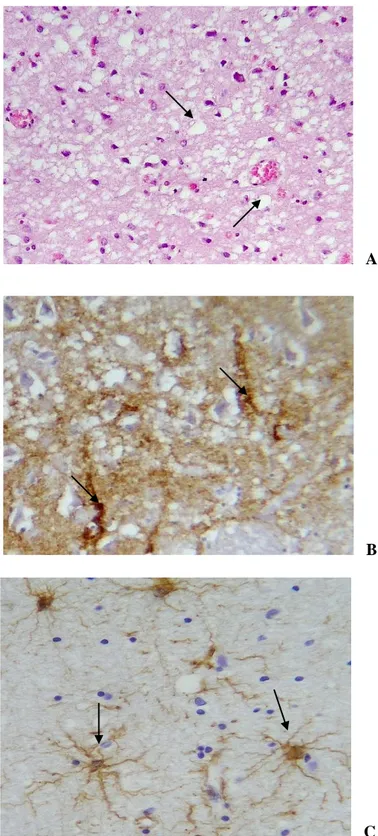 Figure 1. 1. Histological alterations observed in a CJD patient‟s brain. (a) spongiform degeneration; (b)  PrP TSE  deposition; (c) gliosis