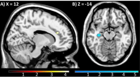 Fig 4. (A) Across all participants, relevance weighted PEs correlate with increased BOLD response in the right ACC ([12 32 22],], t(1,74) = 4.22, p SVC for ACC VOI = 0.032) and (B) decreased left hippocampus response ([-32–18–