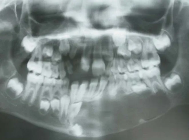 Fig. 2. Frontal cephalogram.