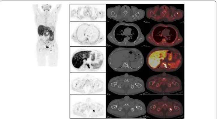 Fig. 3 [ 18 F]FMCH PET/CT and bone metastasis in a patient with wide spread disease