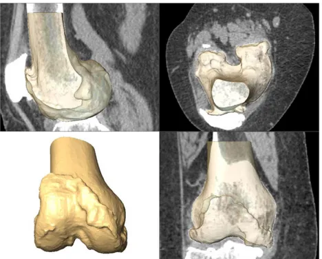 FIGURE 2 One right knee (patient 94) in the study dataset. The reconstructed surface was superimposed in the lateral, axial and coronal views to the corresponding CT scan