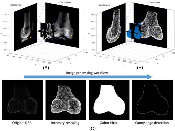 FIGURE 4 Two orthogonal DRR (sagittal and coronal projection) of the patient CT volume (A) and the CT ‐equivalent volume obtained from the morphed surface (B)