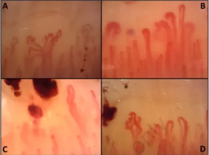 Figure 1 - Nailfold videocapillaroscopy showing a scleroderma pattern, characterized by dis- dis-organization of the vascular array (A, D), reduction of capillary density (A, B, D), enlarged and  giant capillaries (B), microhemorrhages (C, D) tortuosities 