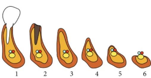 Figure 1: Classification system of six atrophy stages in the mandible according Cawood and Howell (1988)