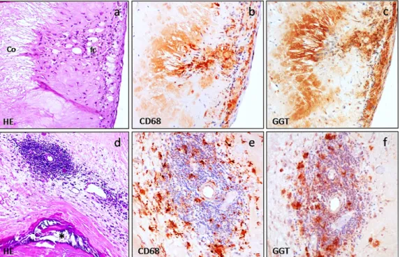 Fig. 1. GGT expression in stenotic aortic valve (I): relationships of GGT with lipids and inﬂammatory cells