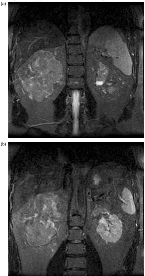 Fig. 1. Nuclear magnetic resonance before surgery. Two coronal sections showing (a) enlargement and complete structural subverting of the right kidney; and (b) a mass involving the upper pole of the left kidney, with the remaining kidney tissue apparently 