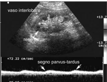 Fig. 5 - Segno del parvus-tardus. Quando è presente ed associato a marcata lateralizzazione delle resistenze, oltre che rappresentare un indice indiretto molto sensibile di stenosi, indica che il rene ischemico è “protetto” da una  mar-cata vasodilatazione