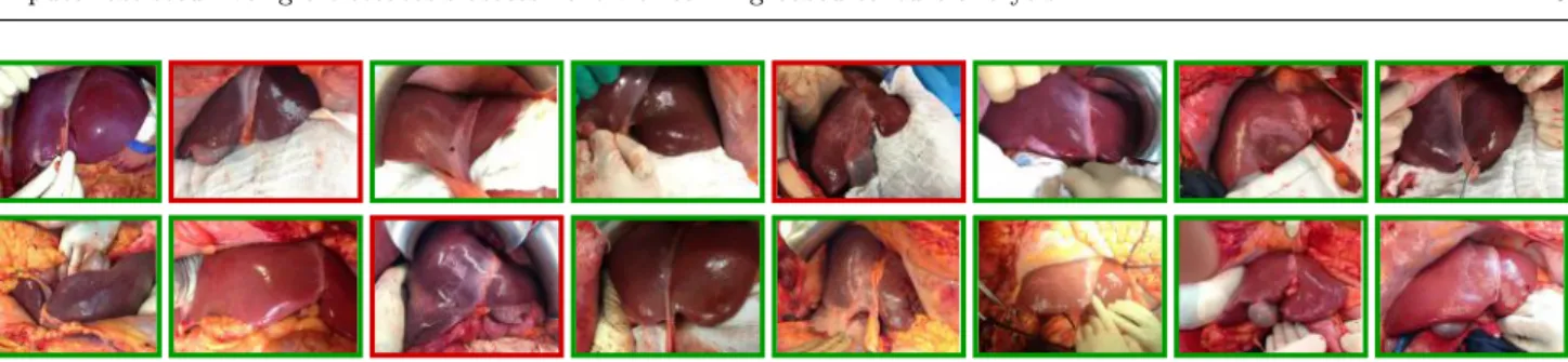 Fig. 10 Samples of classification outcomes for transplanted (first row) and non-transplanted (second row) liver grafts