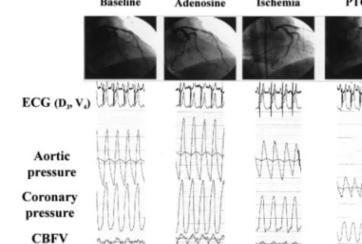 Figure 4. Coronary angiography, electrocardiogram (D 3 , V 4 ), aortic and distal coronary pressure and coronary blood flow velocity (CBFV) in patients with stenosis and transient occlusion of the left anterior descending coronary artery