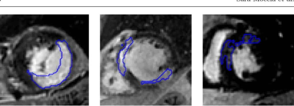 Fig. 4 An example of the masks characterizing the scar presence as drawn by an expert cardiologist for three patients